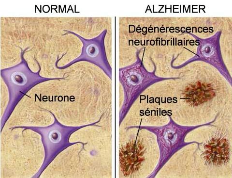 Alzheimer : une maladie infectieuse ? - Source de l'image:http://www.expasy.ch