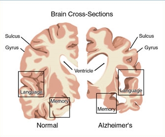 Détecter les signes précoces de la maladie d’Alzheimer - Source de l'image: http://www.innovationlejournal.fr